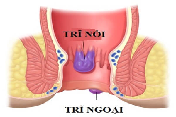 Bệnh trĩ ngoại phải làm sao để điều trị