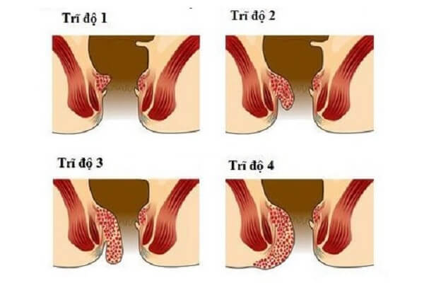 Sa búi trĩ ngày càng nặng khi ở giai đoạn cuối