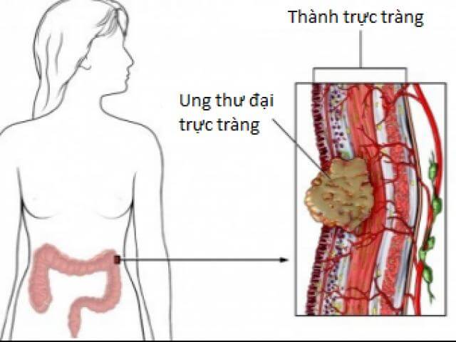 Ung thư trực tràng có thể xảy ra